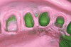 (2.) A patient presented with a missing lateral incisor. The patient was treatment planned to receive a fixed dental prosthesis retained by the adjacent central incisor and canine.