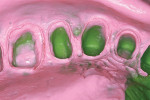 Figure 6  Impressions made for all-porcelain crowns.