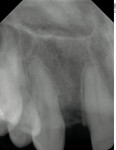 Figure 1  Preoperative radiograph and clinical view of small incisor space after orthodontics and GBR bone grafting.