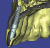 (5.) Virtual articulation of maxillary and mandibular optical impressions.