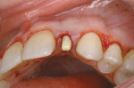 Figure 10  After placement of the 3-mm Unibody implant, a temporary plastic snap cap was placed onto the one-piece abutment.