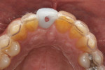 A tooth-form wax-up has been translated into this scanning appliance. Note the “negative” image center of the tooth, which will indicate ideal implant location, as well as inspection windows on teeth Nos. 5, 6, 11, and 12 to ensure complete seating of the appliance.