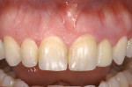 Figure 13  The immediate non-occlusal loaded temporary at day 1 of the combined implant and crown-lengthening surgery and 1 week post-operatively. Note the excellent healing and esthetics.