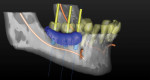 The 3D reconstruction of the patient and optical scan of the case are merged to allow for digital
planning of the case. Virtual teeth (Nos. 29 through 31) and a soft-tissue mask (blue)
were created based on the optically scanned wax-up. They demonstrate the extent of
bone augmentation required to enable a ceramo-metal restorative outcome.