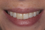 The patient presented with a chief complaint of poor esthetics of teeth Nos. 8 and 9. The
patient didn’t like the poor esthetics of the composite, the canted midline, or the tooth size discrepancy between the two teeth.