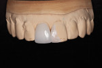 The porcelain restorations were made using preoperative photographs, photographs of the prepared teeth, two sets of upper and lower impressions, an impression of the provisionals, and written details of the required outcome and the patient’s goals.