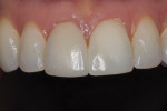 The patient was satisfied with the final restoration after improving the color/value, shape, and esthetics of teeth Nos. 8 and 9 while correcting the canted midline.