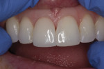 This image shows the try in of veneer Nos. 8 and 9; note that No. 9 is not cemented yet, and therefore finishing and polishing has not taken place. Prior to finishing and polishing, the incisal edge is overcontoured and the margin is detectable.