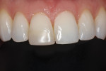 The patient decided to move forward with a porcelain veneer to replace the composite bonding on tooth No. 8, and a porcelain non-prep chip veneer to correct the canted midline.