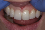 This image shows how severe the cant was with the corrected midline when veneer No. 8 is tried in, before veneer No. 9 is tried in.
