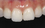 A female presented with a broken incisal edge on tooth No. 9 (central incisor) and recurrent decay and a failing restoration on tooth No. 10 (lateral incisor).