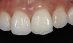 Using a complex layering technique, tooth No. 10 was successfully restored. In recreating the incisal edge of tooth No. 9, a lingual shell was first sculpted with G-aenial Sculpt A1.
