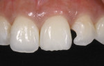 Minimally invasive Class IV tooth preparations were performed using micro-prep burs. To create an invisible margin, scalloped bevel margins were used along the facial cavosurfaces of both teeth.