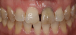 The patient presented with a discolored maxillary left central incisor.