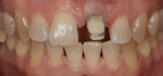 Grayness and patches of discoloration around the cervical and middle thirds.