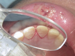 Lingual extent of preparation on teeth Nos. 8 and 9.