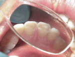 Lingual view of fractured teeth Nos. 8 and 9.