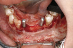 Figure 21  Implant placement after verification.