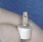 Figure 22  The use of Hex-Lock Contour Abutment analogs.
