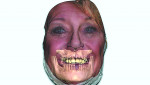 Fig 4. 3D virtual patient composed with volumetric data of craniofacial hard tissue and 3D extraoral facial scan. This 3D virtual patient can be used to gain patient’s preoperative
approval and design a surgical and prosthetic plan.