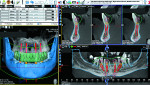 Fig 6. Surgical and prosthetic plan for a mandibular edentulous implant treatment.