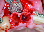 Fig 1. Postextraction of 2 anterior teeth at the conclusion of orthodontic therapy.