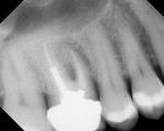 Figure 1  Patient is asymptomatic, with a wellcircumscribed lesion around the mesiobuccal root of the upper right first molar. No tenderness or swelling over the buccal or palatal aspect of the roots. Note the presence of a non-purulent periodontal p