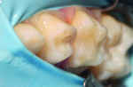 Fig 8. Case 2: preoperative photograph of isolated molars.