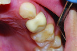 Fig 11. Two-year postoperative photograph, occlusal view.