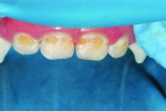Fig 1. Case 1: preoperative photograph of isolated incisors.