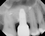 Figure 3  Radiograph 1 year after the extraction graft.