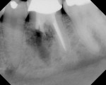 Figure 4  Preoperative signs and symptoms: patient complained of localized tenderness. Preoperative radiographs demonstrated a diffuse radioleucency around the mesial root. Clinical signs: tenderness to palpation, mild intraoral swelling, no periodon