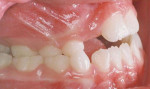 Fig 2. Pretreatment intraoral photograph, right side view.
