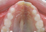 Fig 4. Pretreatment intraoral photograph, maxillary occlusal view.