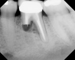 Figure 5  Radiographic image 10 months postoperative. The patient was clinically asymptomatic, but there was a periodontal pocket at the buccal furcation. The patient agreed to have this tooth replaced by an implant.