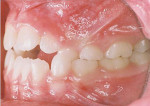 Fig 3. Pretreatment intraoral photograph, left side view.