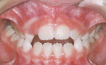 Fig 1. Pretreatment intraoral photograph, frontal view.