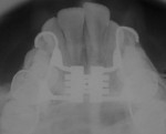 Fig 6. Occlusal radiography before expansion.