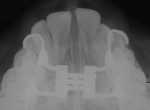 Fig 8. Occlusal radiography after final expansion.