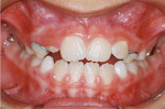 Fig 9. Intraoral photograph post-expansion.