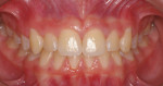 Fig 12. Intraoral photograph 5 years post-treatment, frontal view.