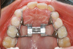 Fig 10. Occlusal photograph post-expansion.