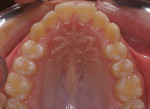 Fig 13. Intraoral photograph 5 years post-treatment, maxillary occlusal view.