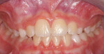 Fig 11. Intraoral photograph 1 year post-treatment.