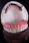 Fig 8. The completed denture.