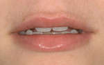 Figure 2  Image of the lower one third showing tooth display at rest. The display was measured to be between 2.5 to 3 mm.
