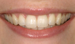 Figure 3  Lower one third smiling image showing the relationship of the incisal edge to the lower lip during smiling.