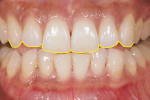 Figure 4  Image showing the smile line with a gull-wing effect.