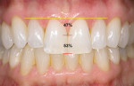 Figure 7  Image showing the gingival line on the same patient. Note the lateral and central apical position of the gingival margin is on a straight line that is completely horizontal.