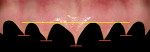 Figure 8  Image demonstrating the measurements of the ideal gingival scallop, with the percentages showing the papilla length relative to tooth length.